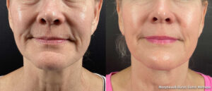 Before and after Morpheus8 Burst — face and neck, 4 treatments