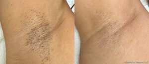 Before and after Fusion laser hair removal — underarm