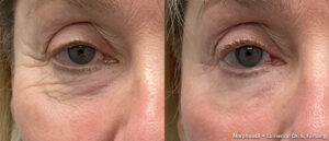 Before and after Morpheus8 Burst and Lumecca Peak — eye area