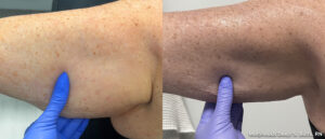 Before and after Morpheus8 Burst Deep — arm skin tightening