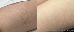 Before and after Lumecca Peak — leg vein reduction