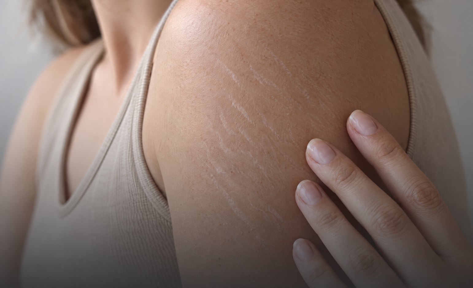 Stretch marks on the upper arm